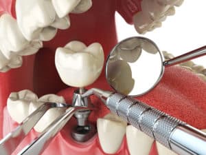 Dental-Implants