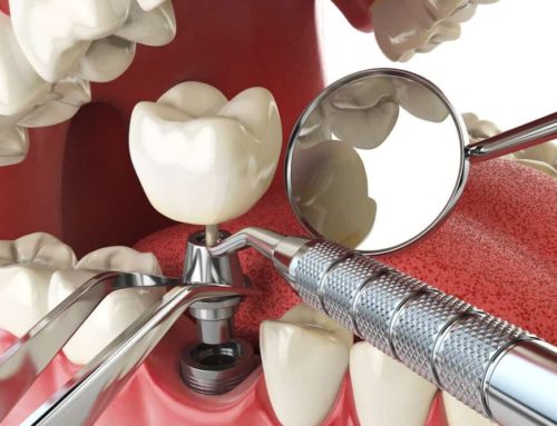 Enjoy A Healthier Future With Dental Implants