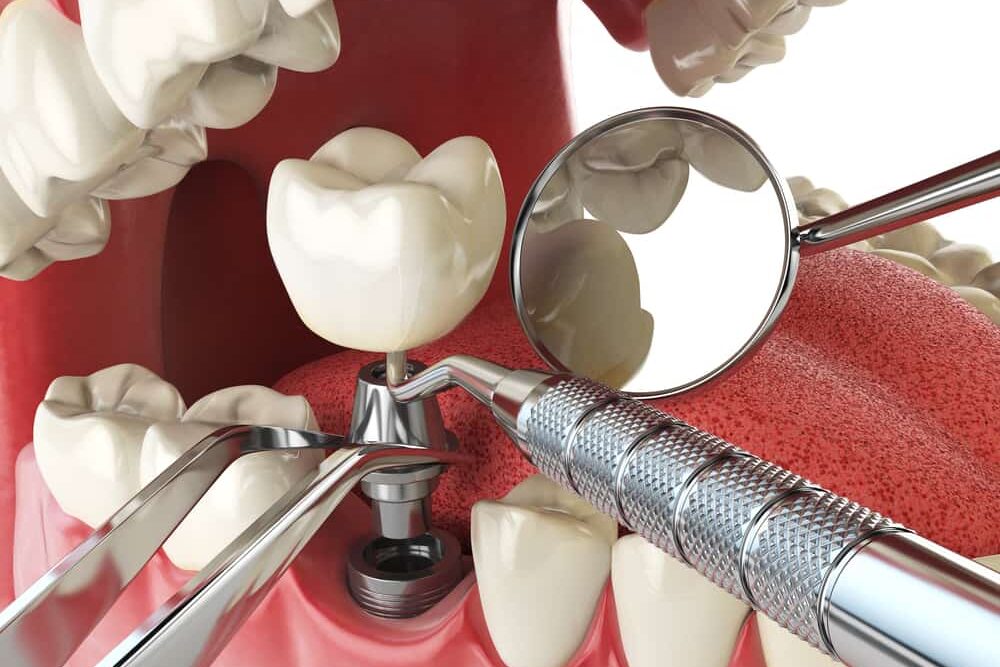 Advancements in Dental Implant Technology