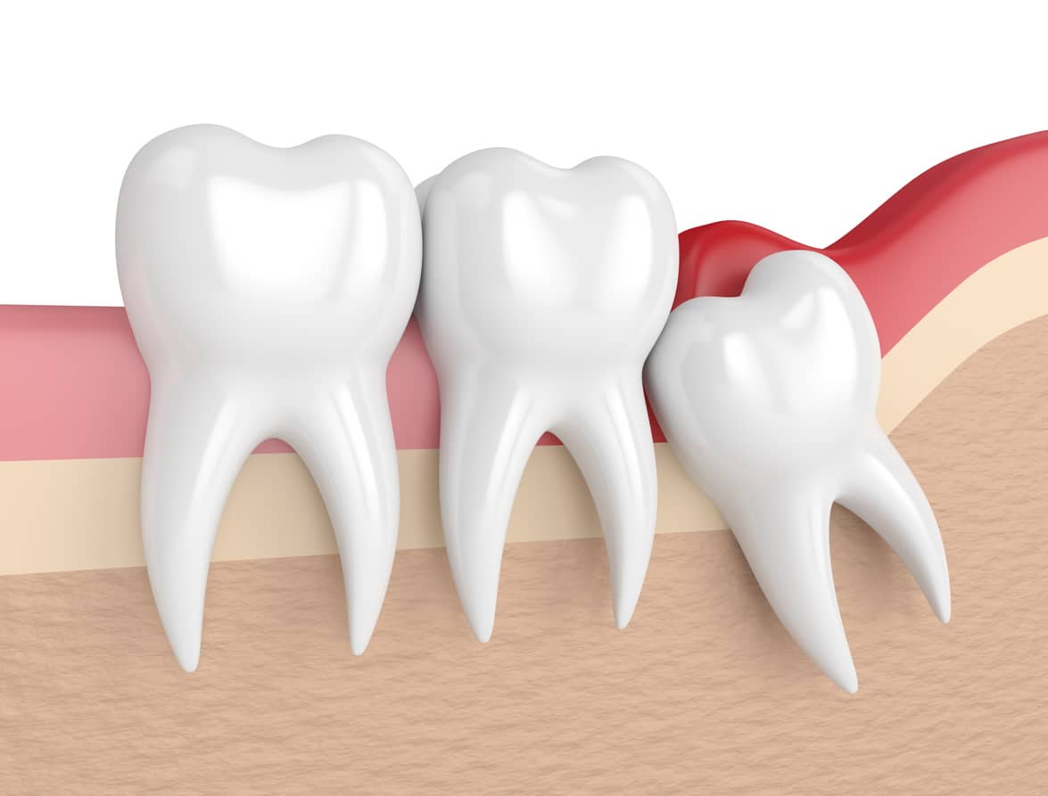 wisdom teeth before and after