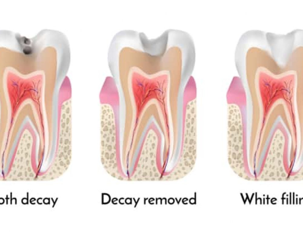 Sensitive Teeth After Wisdom Tooth Extraction Pickett Family Dental