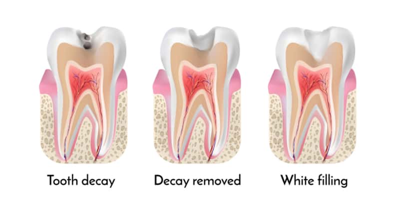 How To Know If You Have A Crack In Your Dental Filling?