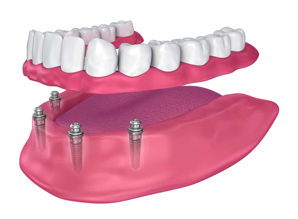 implant overdentures