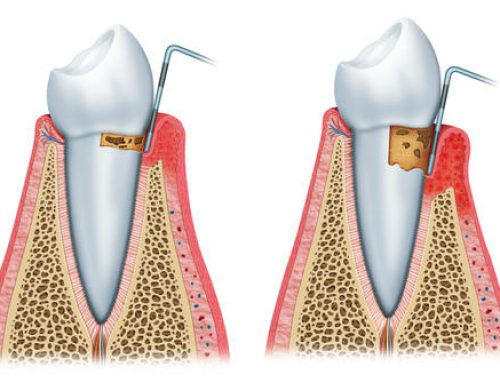 Receding Gums – Everything You Need to Know