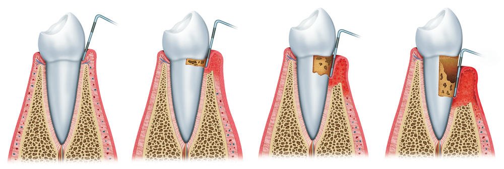 receding gums