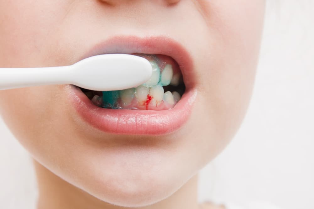 Gums Bleeding While Brushing or Flossing