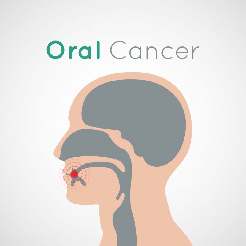 oral cancer screening