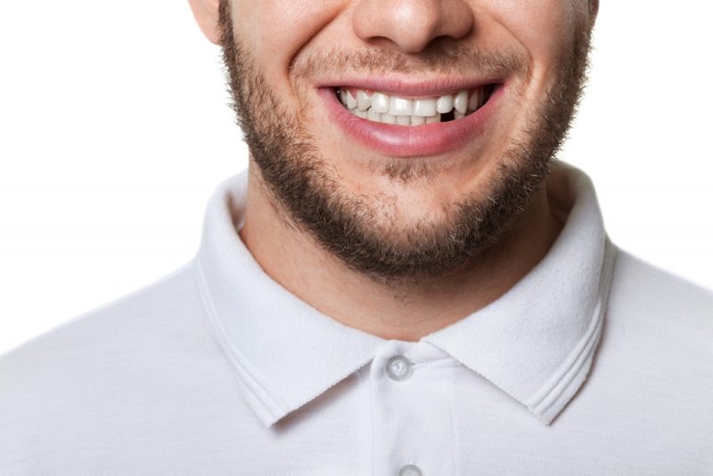 missing teeth missing teeth