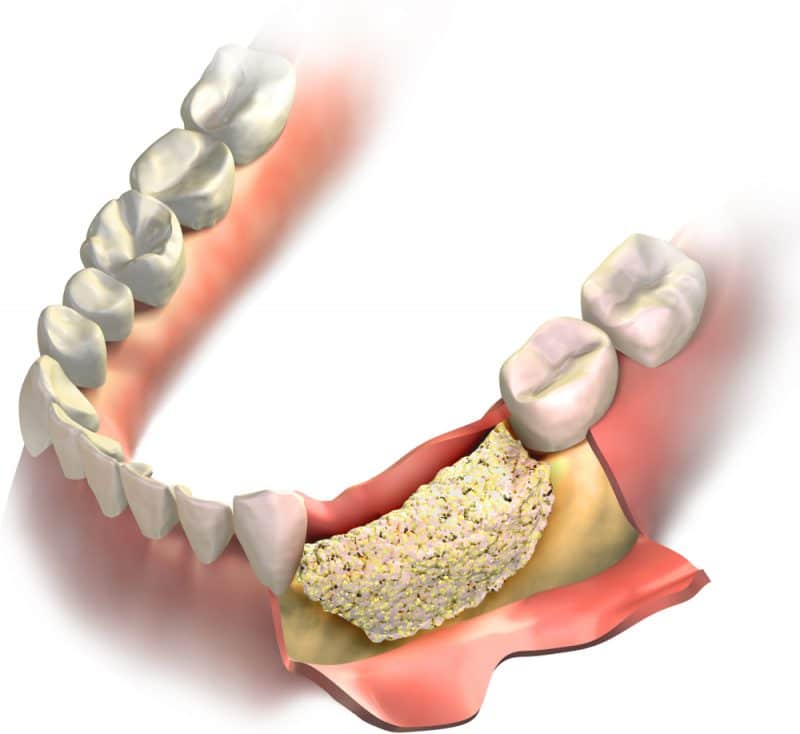 What To Expect During Bone Grafting