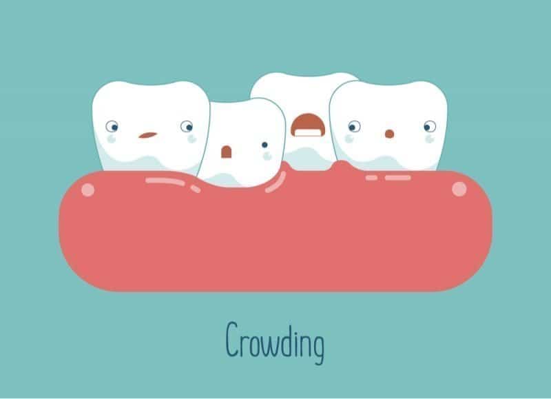 how to fix crowded teeth