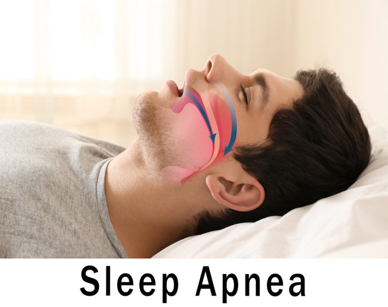 Sleep Apnea Treatment in Keller