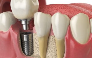 Top 6 Reasons to Consider Dental Implants