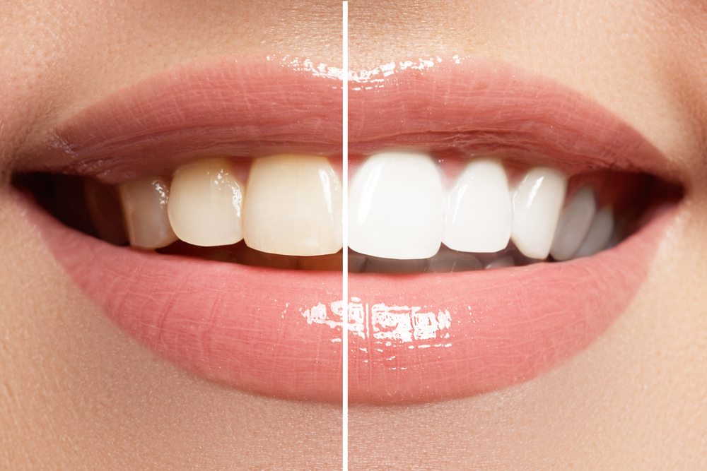 how teeth are whitened at the dentist
