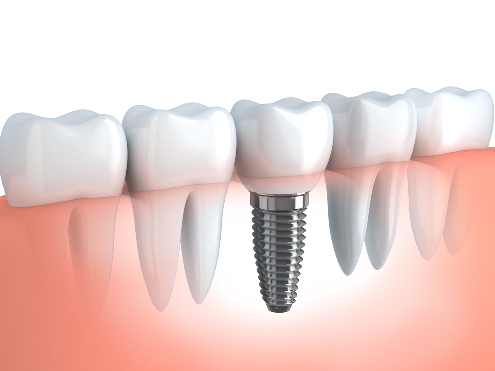 Benefits of All-On-4 Dental Implants