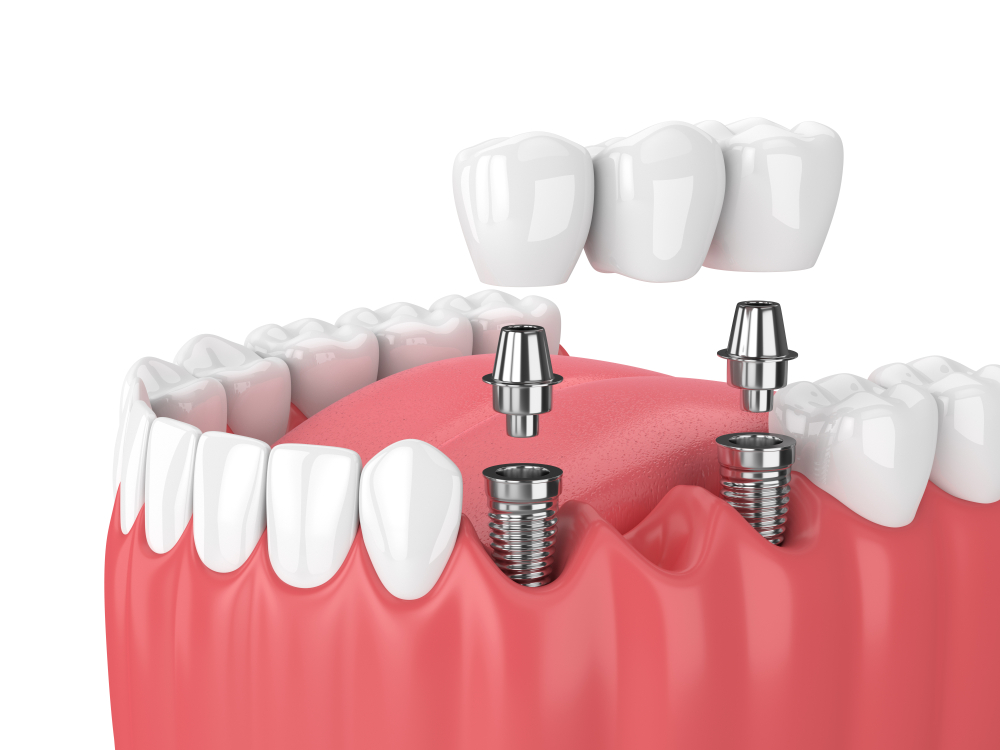 dental bridges replace missing teeth