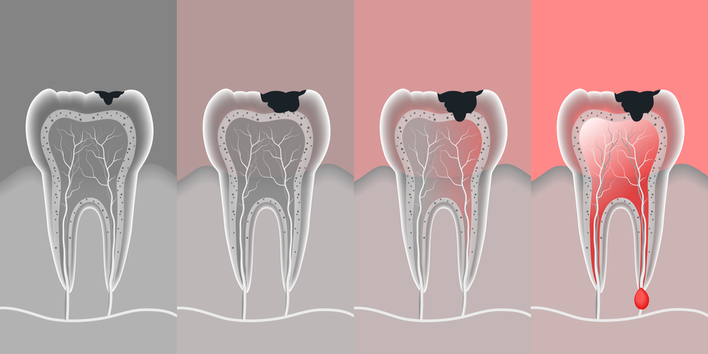 diagnodent cavity detection