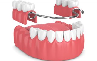 partial dentures