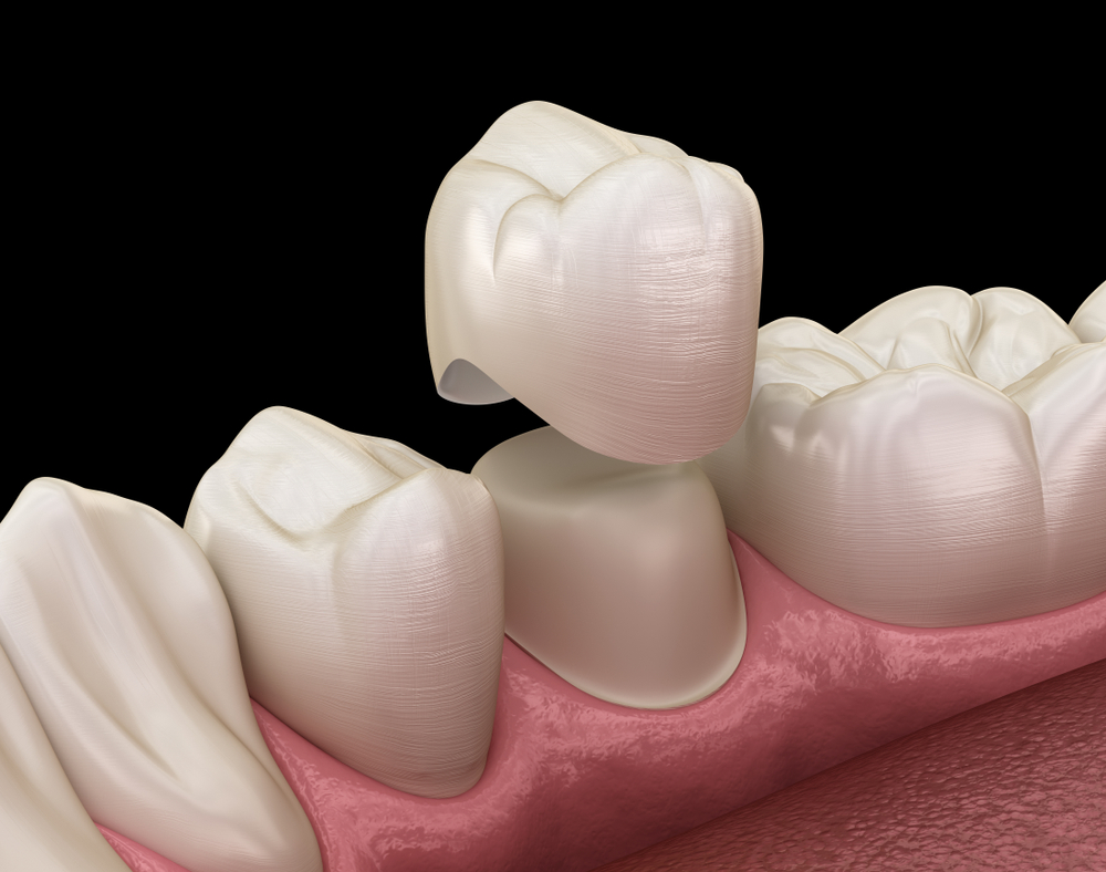 same day dental crowns