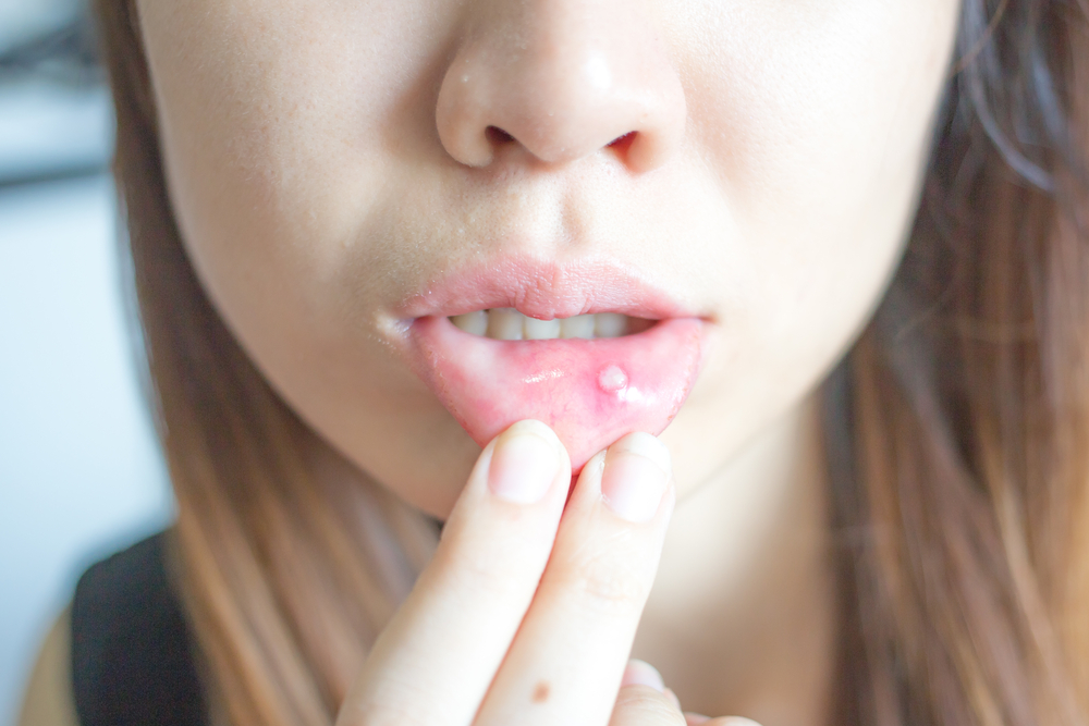 Canker Sores Causes, Symptoms, and Treatment