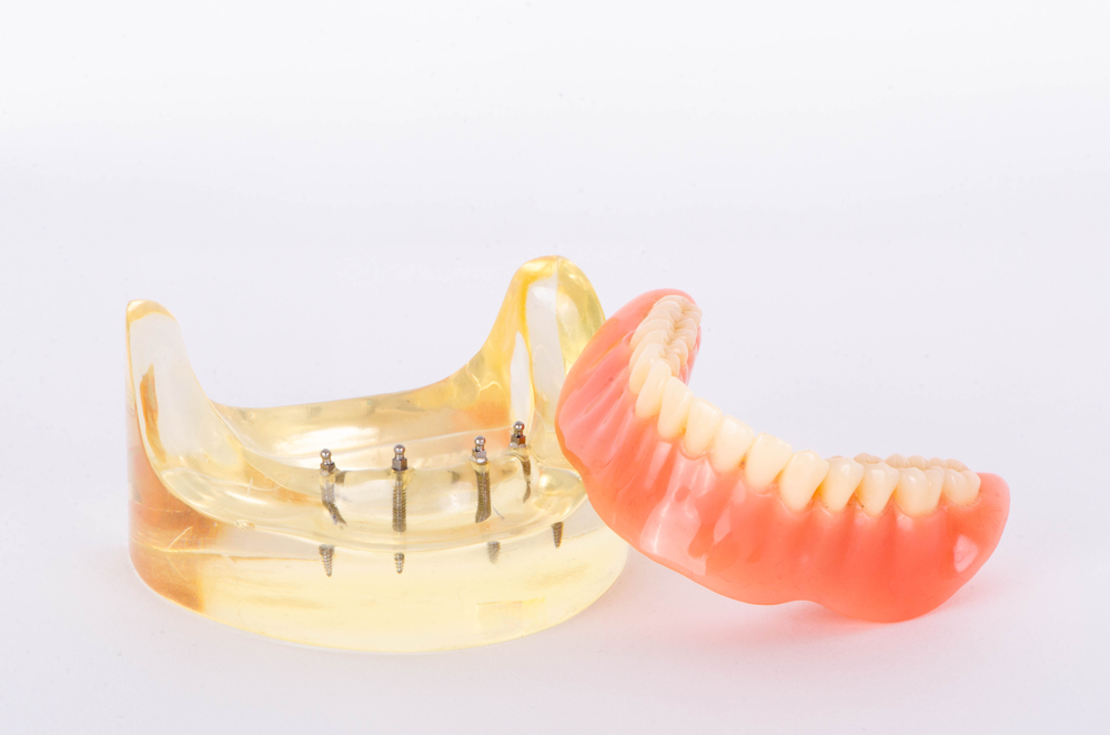 Implant Retained Dentures