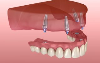 implant supported dentures