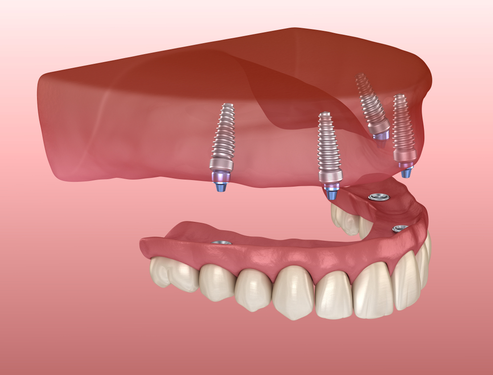 Implant Supported Dentures