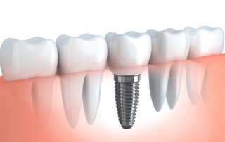 Dental Implants Questions and Answers