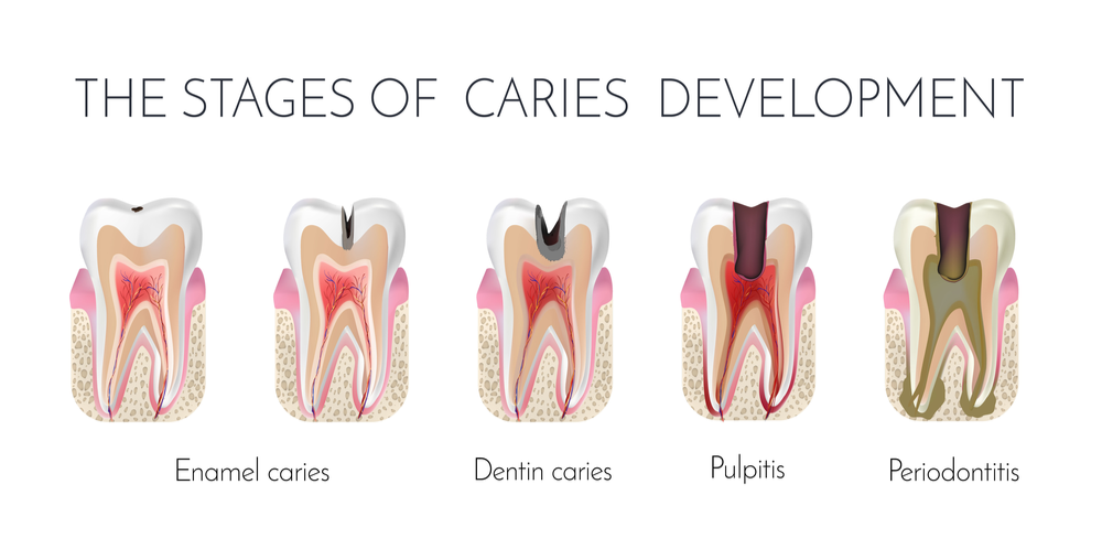 The 5 Stages of Tooth Decay The 5 Stages of Tooth Decay