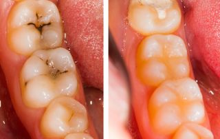 Composite Fillings in Keller TX