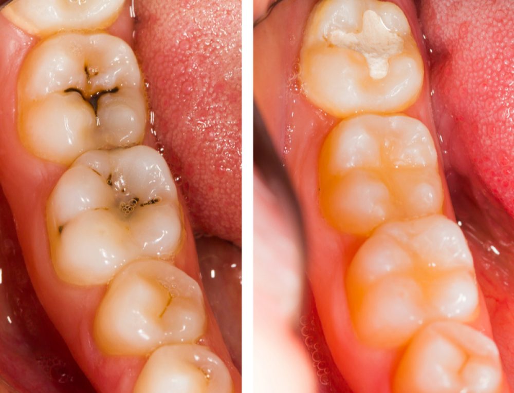 What Causes Chalky Teeth and What You Can Do About It Pickett Family