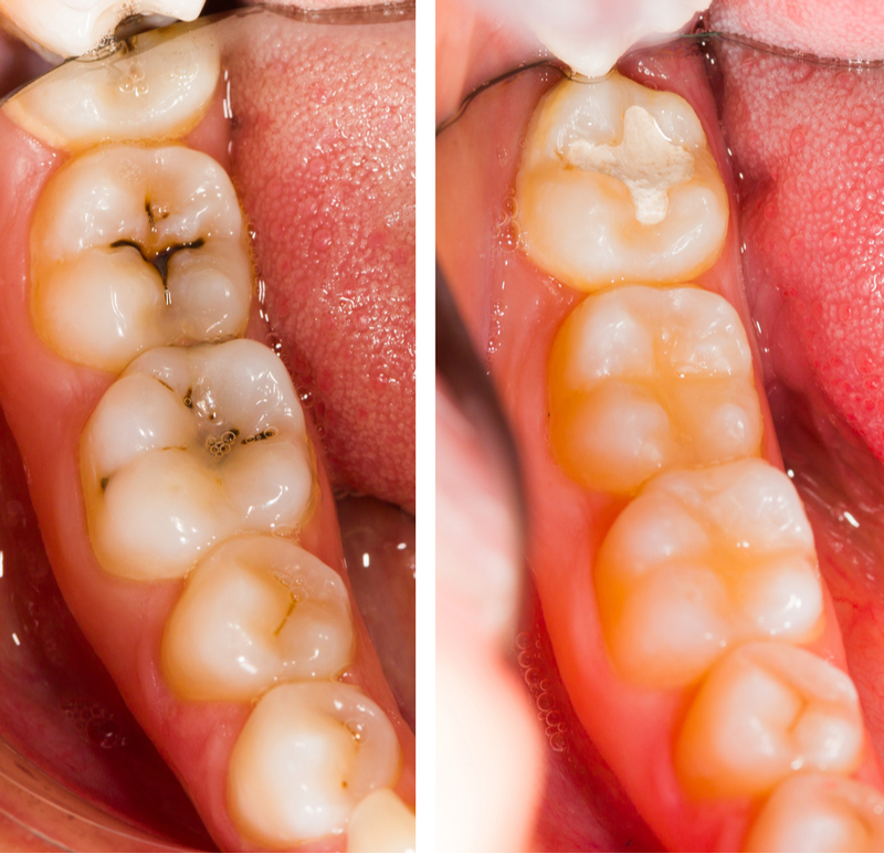 Composite Fillings in Keller TX