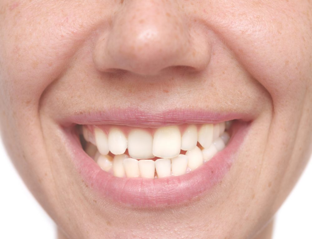 What Causes Chalky Teeth and What You Can Do About It Pickett Family