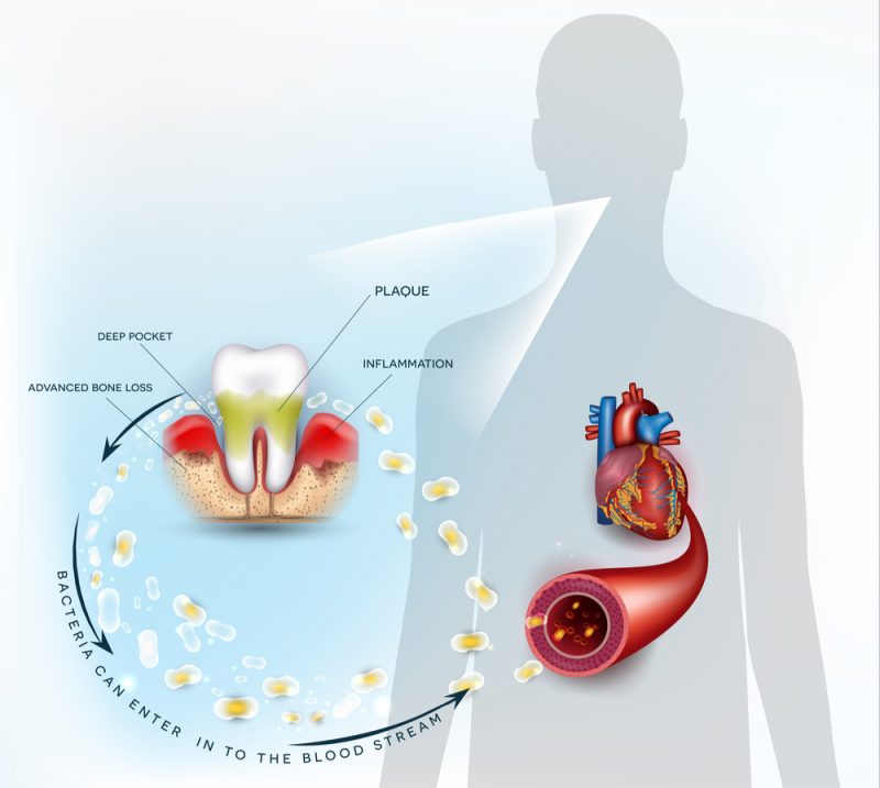 Correlation Between Heart Disease and Periodontal Disease Pickett