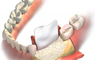 bone grafting for dental implants