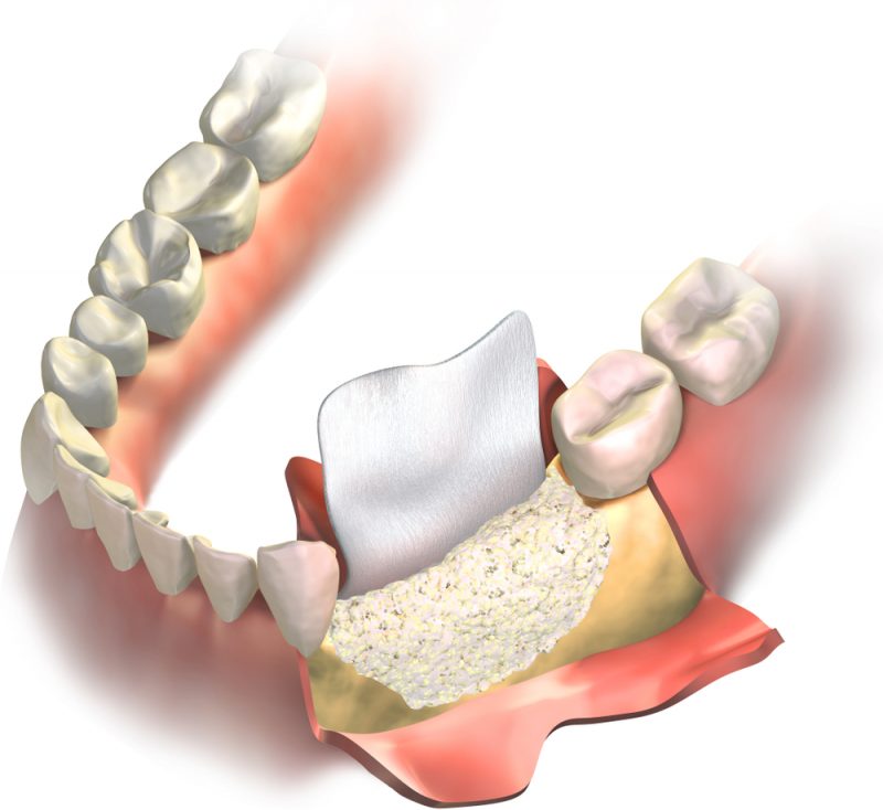 bone grafting for dental implants