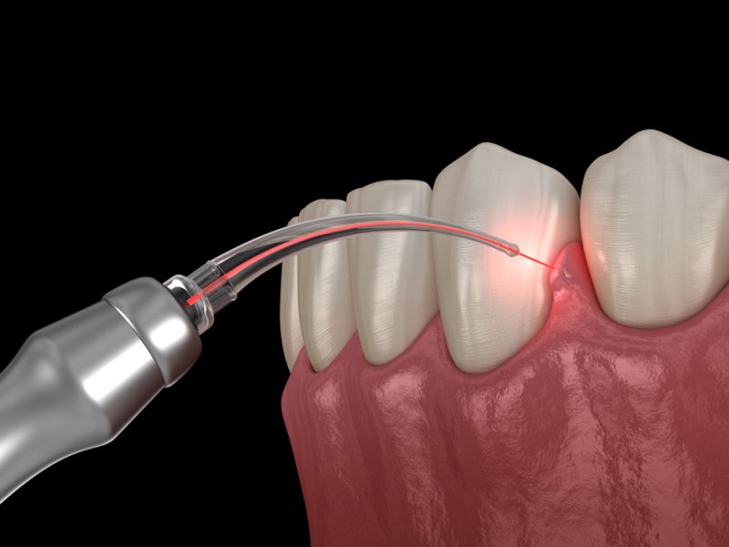 co2 laser dentistry keller tx co2 laser dentistry keller tx