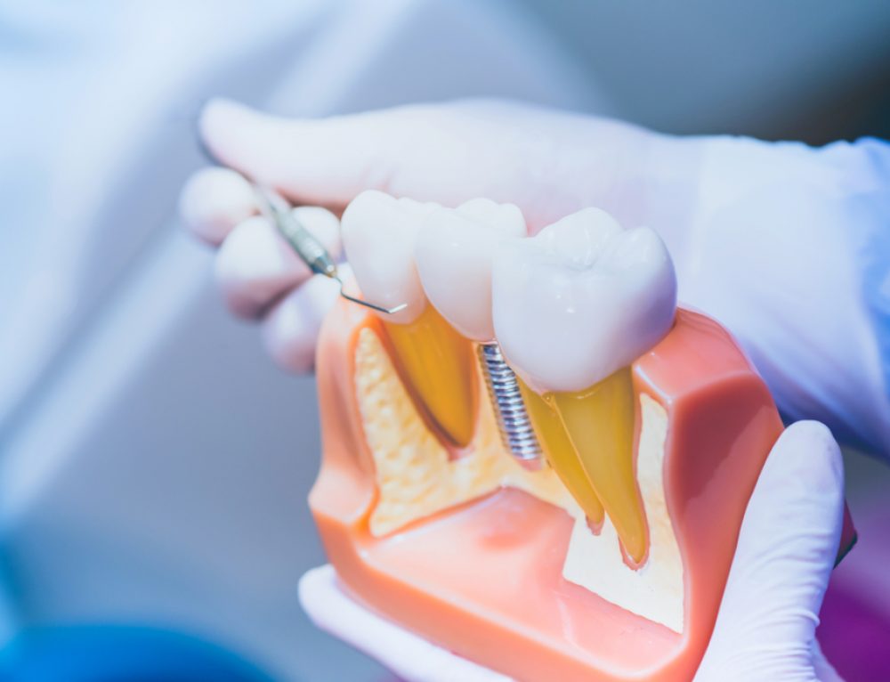What Causes Chalky Teeth and What You Can Do About It - Pickett Family ...