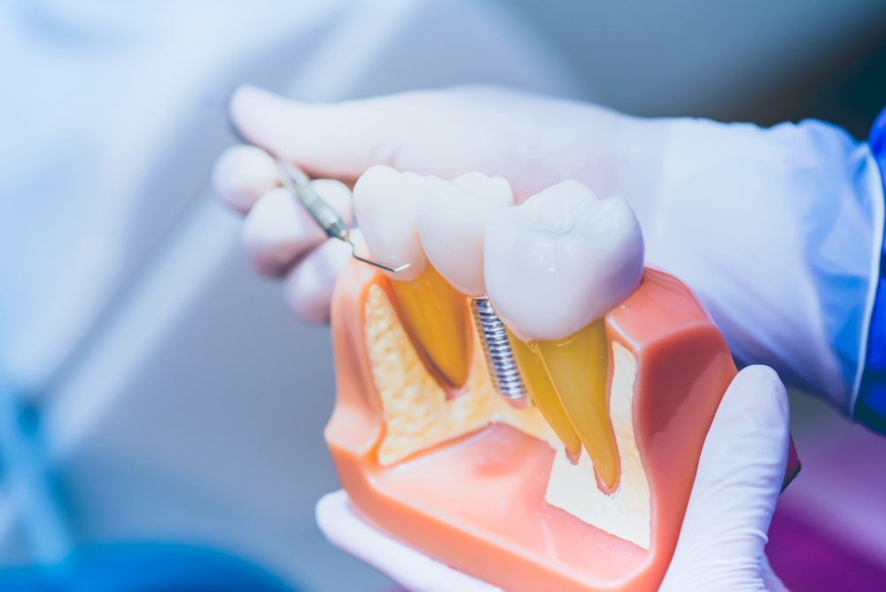 Temporary Dentures vs. Permanent Dentures - Pickett Family Dental