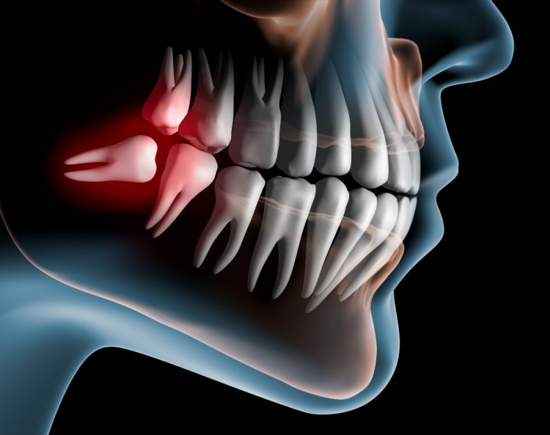 impacted wisdom teeth