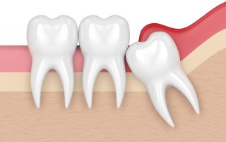 pericoronitis