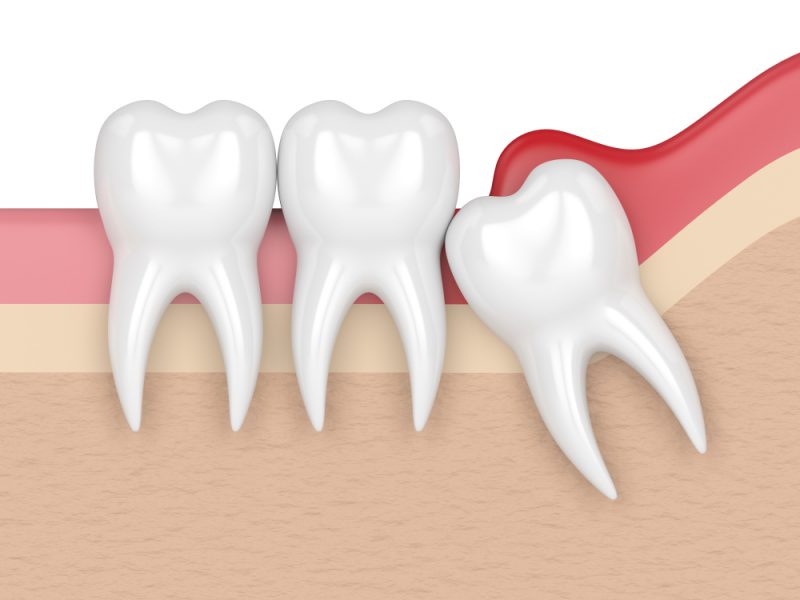 pericoronitis