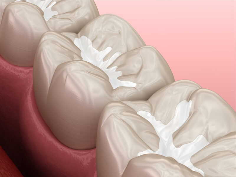 restorative dentistry in keller Restorative Dentistry Keller