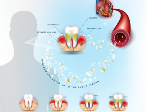 How Gum Disease Affects The Heart