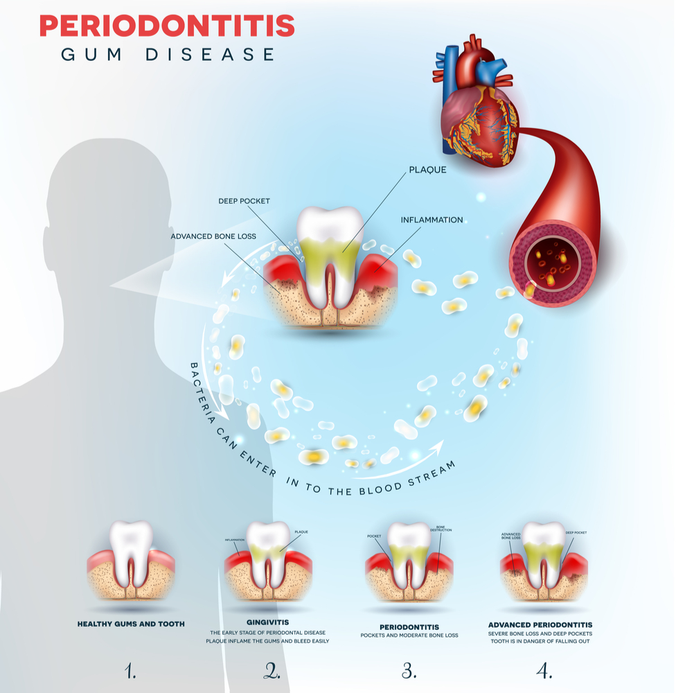 How Gum Disease Affects The Heart