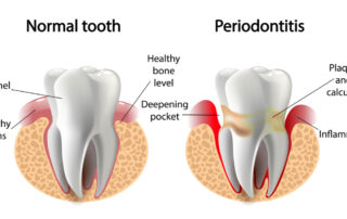 what is gum disease