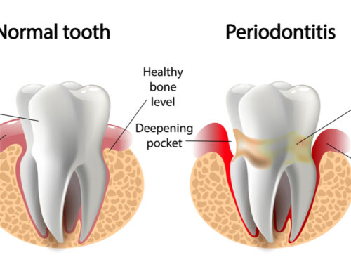What Is Gum Disease?