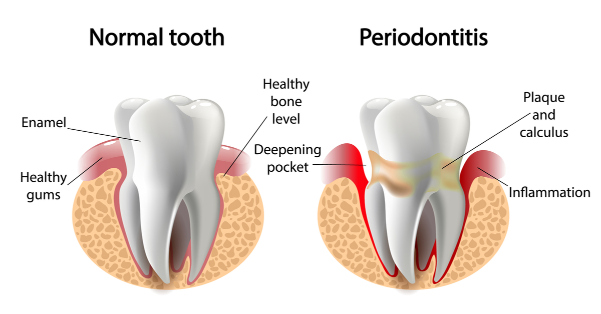 what is gum disease