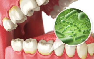 4 types of dental cleanings