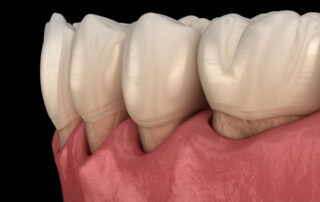 Periodontal Maintenance Cleaning