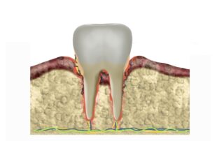 what are periodontal pockets